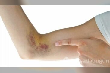 Vücudunuzdaki morarmaların sebebi bakın ne