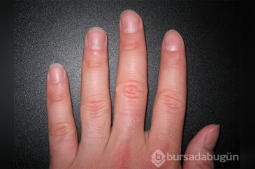 Ellerinizin ortaya çıkardığı 6 şaşırtıcı hastalık