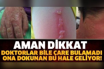 Aman dikkat doktorlar bile çare bulamadı ona dokunan bu hale geliyor!