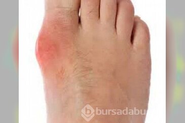 İşte ayakkabı vurmasına ne iyi gelir?