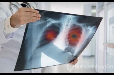 Akciğer kanseri erken teşhisle tedavi edilebilir
