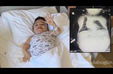 24 kilo ağırlığındaki Nurdan'ın yumurtalıkla...