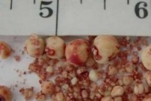 B&ouml;breğinden 198 taş &ccedil;ıktı