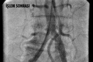 Bacak ana damarı tamamen tıkalı hastaya ameliyatsız &ccedil;&ouml;z&uuml;m