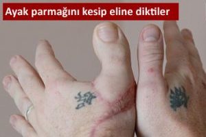 İnanılmaz ama ger&ccedil;ek..Eline ayak parmağını diktiler
