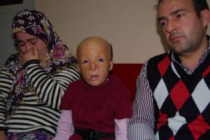 T&uuml;rkiye'nin ilk y&uuml;z nakli k&uuml;&ccedil;&uuml;k Buse'yi umutlandırdı