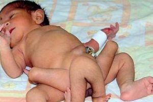 6 bacaklı bebek