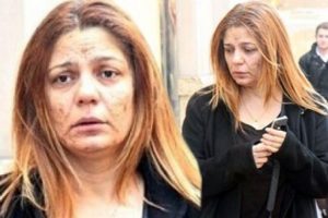 İzel'in y&uuml;z&uuml; bir gecede nasıl bu hale geldi