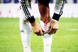 Ronaldo'nun dizi işte b&ouml;yle yarıldı!