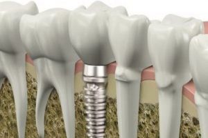 Diş implantı uygulamalarında, 3 boyutlu dijital d&ouml;nem