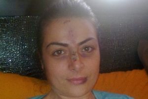 K&ouml;peği severken y&uuml;z&uuml;nden yaralandı