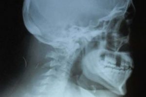 Boynunda iğne unutan doktorlara tazminat &ouml;deyecek