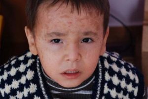Yılan derili &ccedil;ocuklara teşhis konulamıyor