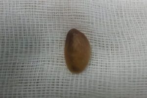 Akciğerinden fıstık kabuğu &ccedil;ıktı
