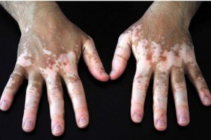 Vitiligo tedavisinde protein desteği