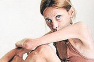 Anoreksiya tedavisinde umut verici gelişme