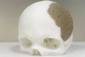 3D yazıcıda kafatası protezi &uuml;retildi