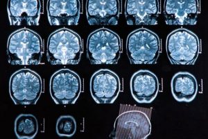 Parkinson'un su&ccedil;lusu bulundu