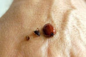 V&uuml;cuda yapışan keneyi &ccedil;ıkarmanın kolay yolu bulundu !