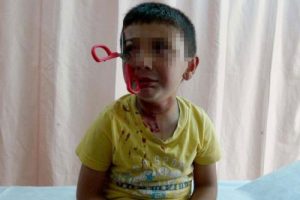 Sokakta oynayan &ccedil;ocuğun g&ouml;z&uuml;ne makas saplandı