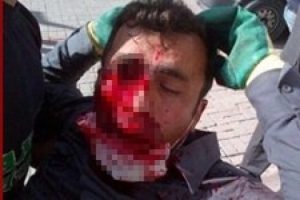 Ankara'da vurulan belediye iş&ccedil;isi g&ouml;z&uuml;n&uuml; kaybetti