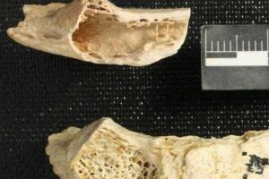 Neandertal insanda kanser t&uuml;m&ouml;r&uuml; bulundu