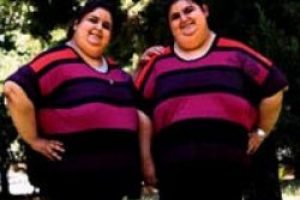 Obez ikizlere ikiz ameliyat