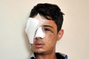 Biber gazı kaps&uuml;l&uuml; isabet eden g&ouml;z&uuml; alındı
