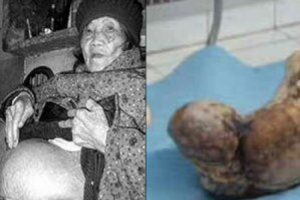 60 yıl hamile kaldıktan sonra taş bebek doğurdu