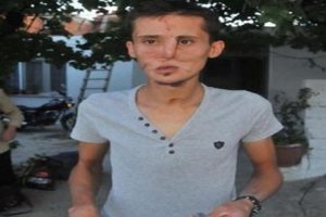 Y&uuml;z nakli sevinci iki saat s&uuml;rd&uuml;