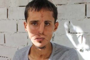 Y&uuml;z nakli hayali yarım kaldı