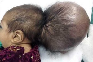 İki kafalı bebek kurtarıldı