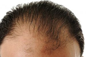 Saç dökülmesinin psikolojik sonuçları