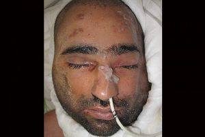 Y&uuml;z nakli yapılan &Uuml;sl&uuml;n'&uuml;n ilk fotoğrafı