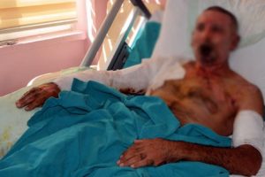 Zift ısıtma ocağı patlayınca yaralandı
