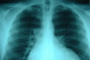 İ&ccedil; organlarının yerinin ters olduğunu 42 yaşında &ouml;ğrendi