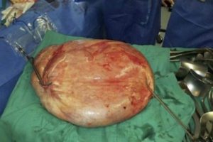 Hastadan 25 kilogramlık t&uuml;m&ouml;r alındı