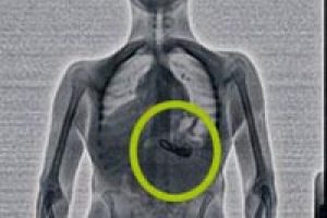 &Ccedil;aldığı kolyeler X-Ray'de &ccedil;ıktı