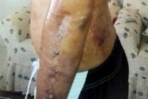Epilasyon yaptırayım derken işkence &ccedil;ekti