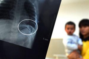 Bebeğin akciğerinden bakın ne &ccedil;ıktı?