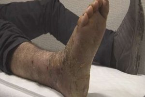 Kopan ayağı dikildi, askerlik hayali yıkılmadı