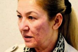 G&uuml;zelleşmek istedi, y&uuml;z&uuml;n&uuml;n yarısı yandı