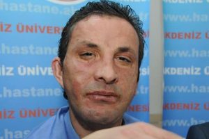 T&uuml;rkiye'nin ilk y&uuml;z nakli 2 yaşında