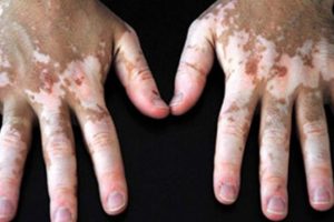 Vitiligo hastaları i&ccedil;in yeni umut