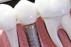 Bu proje implantta dışa bağımlılığı bitirecek