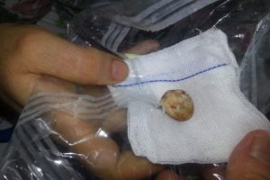 Safra kesesinden &ccedil;ıkan taş şaşırttı!