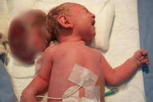 İki kafalı bebek g&ouml;renleri şok etti