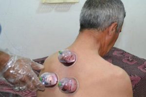 ﻿ Hacamat tedavisine ilgi b&uuml;y&uuml;k