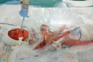 54 gram doğan bebek bakın nasıl hayata tutundu?