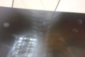 Bursa'da bebek &ouml;yle bir şey yuttu ki doktorlar bile şaşkına d&ouml;nd&uuml;!